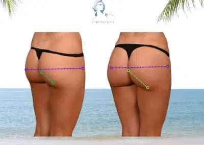 bbl tunisie, Découvrir le lifting brésilien, Comment embellir la zone des fesses, lipofilling fesses tunisie, lipofilling fesse tunisie