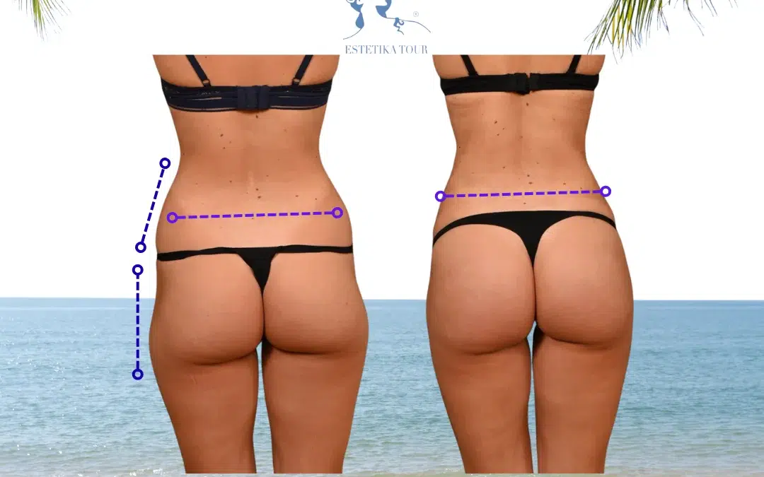 Augmentation des fesses en Tunisie tout compris