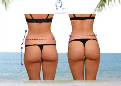 Augmentation fessier BBL Tunisie, Augmentation des fesses en Tunisie tout compris