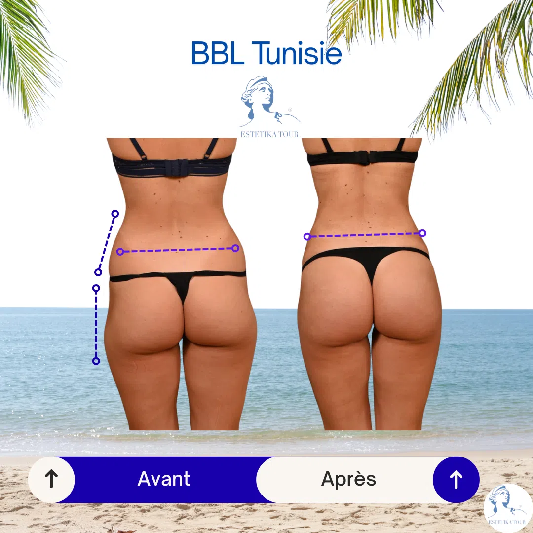 Augmentation fessier BBL Tunisie