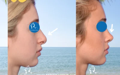 Quel est le prix d’une chirurgie du nez ?