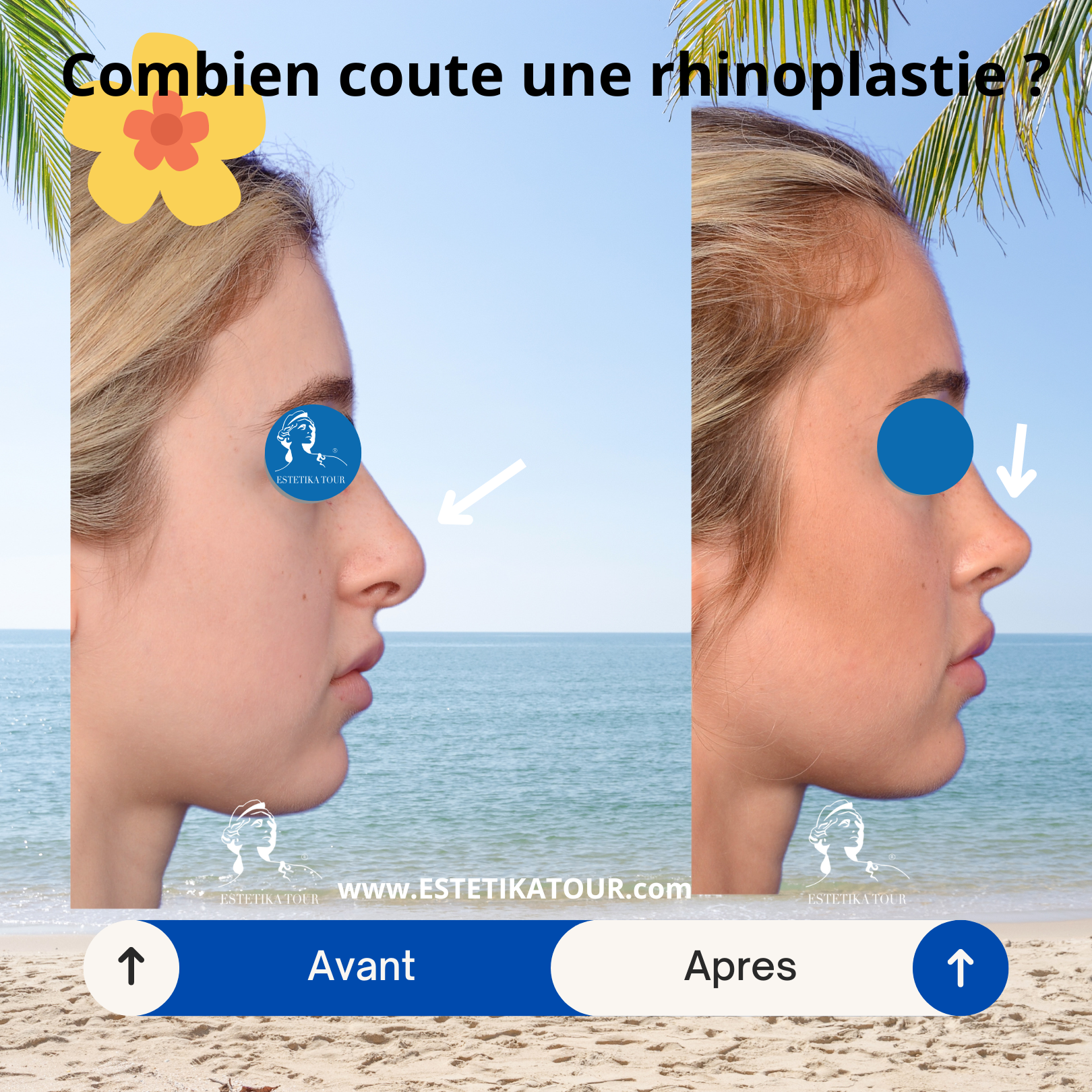 Combien coute une rhinoplastie ? , Quel est le prix d'une rhinoplastie en Tunisie, Quel est le prix pour refaire le nez ?