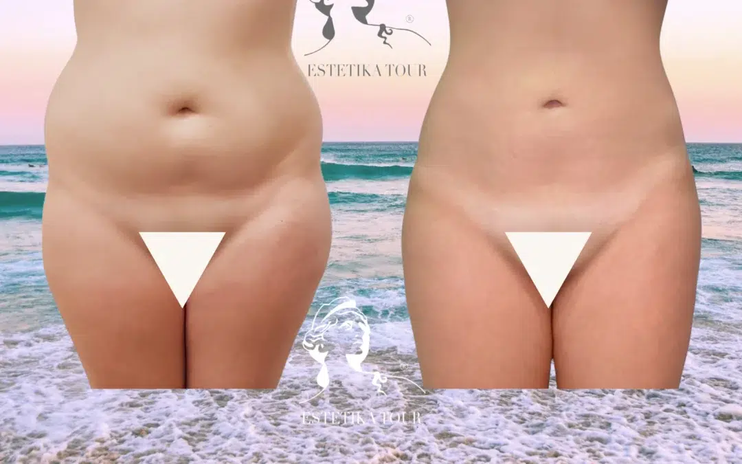 Liposuccion ventre prix
