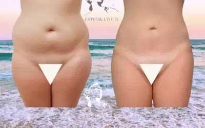 Liposuccion ventre prix