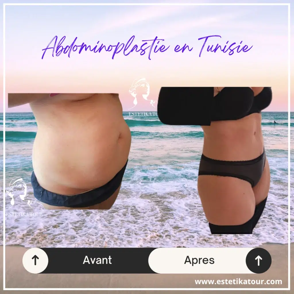 Prix abdominoplastie pas cher tunisie, abdominoplastie tunisie, Quel est le prix d'une abdominoplastie en Tunisie ? , Prix abdominoplastie tunisie,