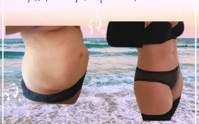 Prix abdominoplastie 1 Prix abdominoplastie ou Plastie Abdominale
