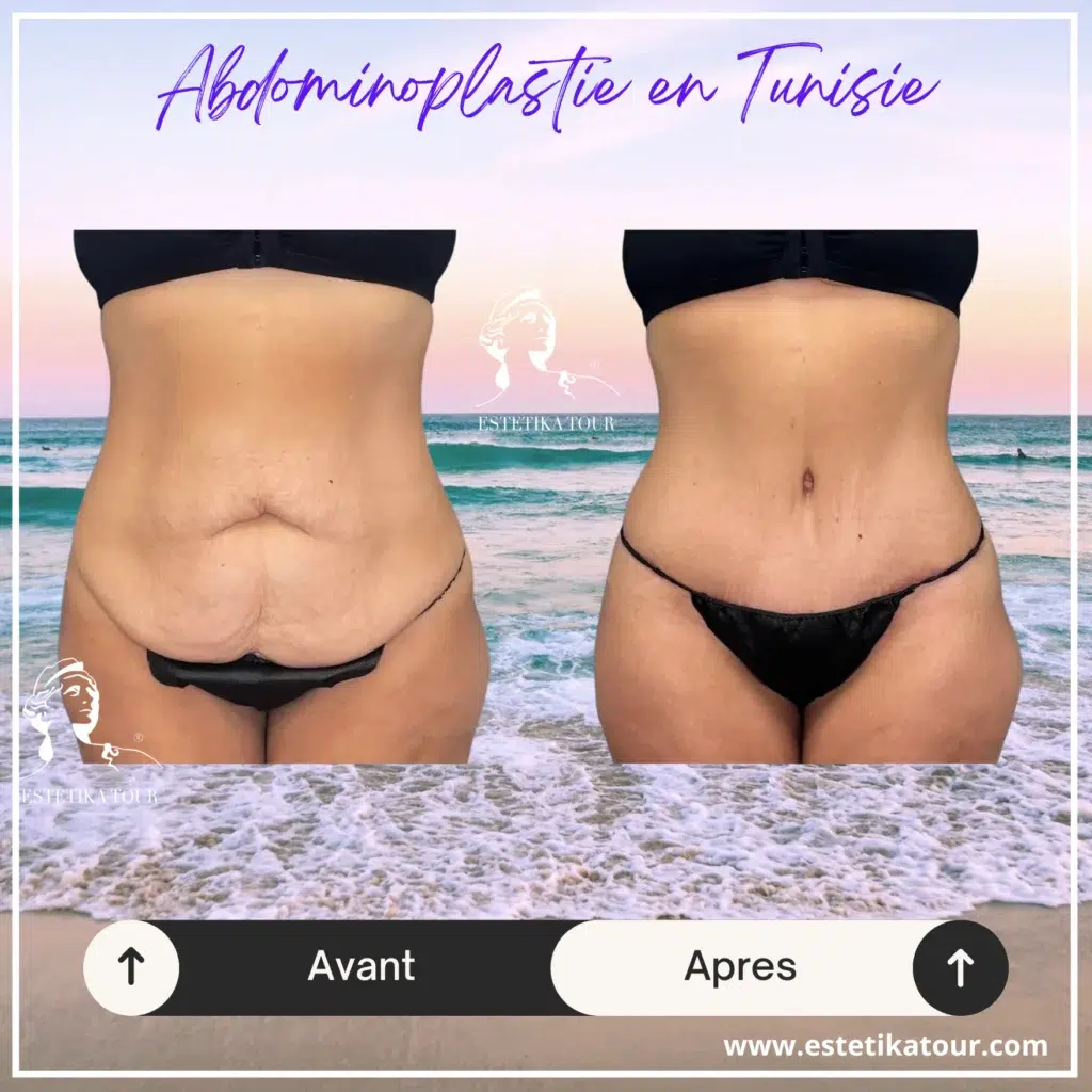 Prix abdominoplastie en Tunisie