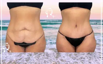 Prix abdominoplastie en Tunisie Chirurgie esthétique du ventre photos