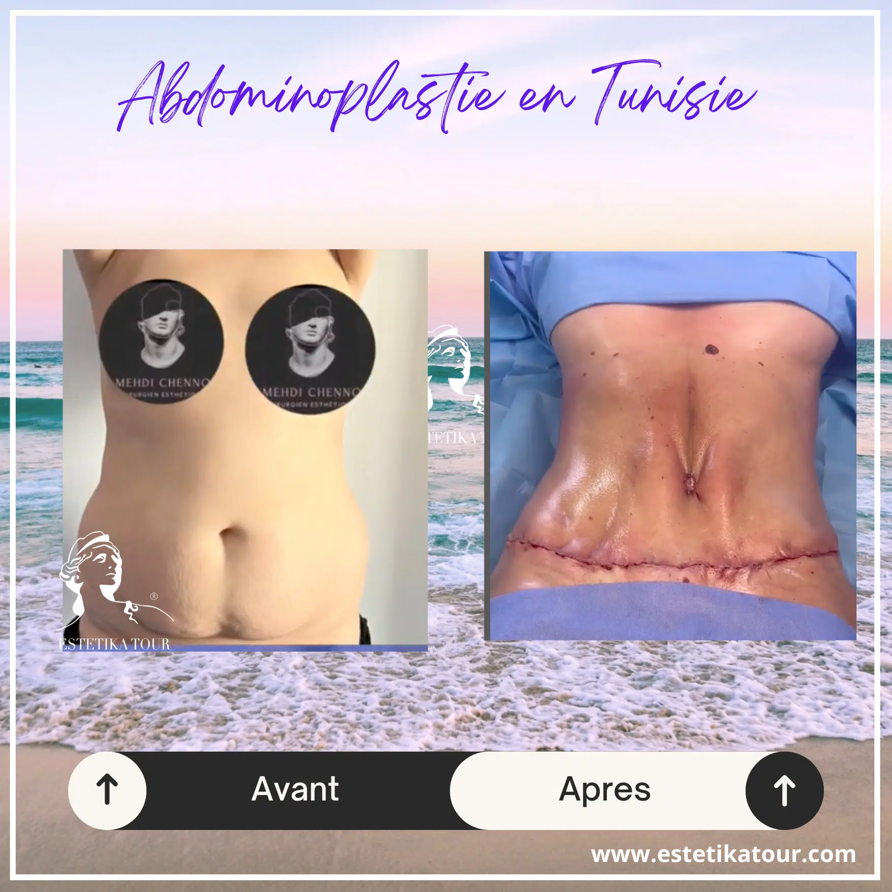 Prix abdominoplastie tunisie