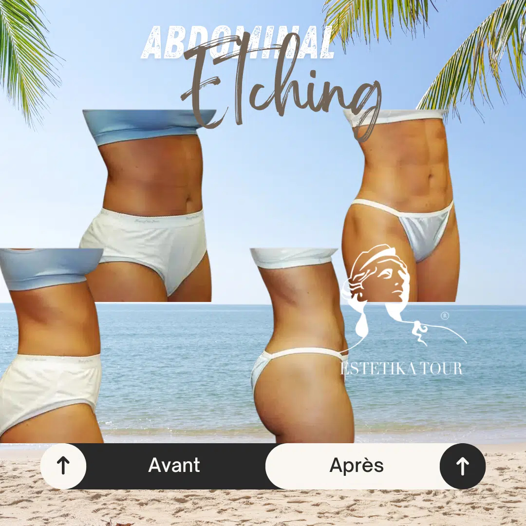 Abdominal etching femme ete