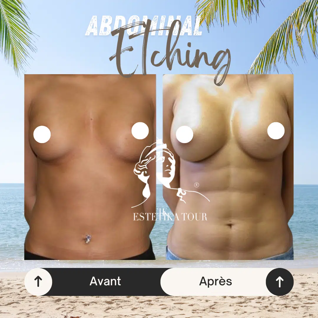 Abdominal etching femme