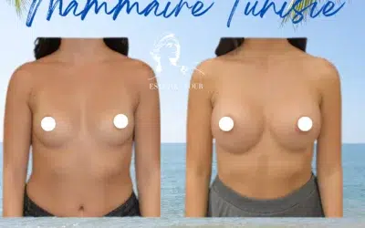 Augmentation mammaire tunisie prix Refaire ses seins : technique