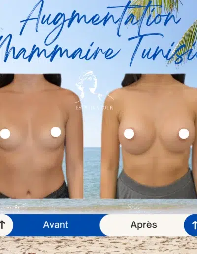Augmentation mammaire tunisie prix, Prix pour augmentation mammaire,
