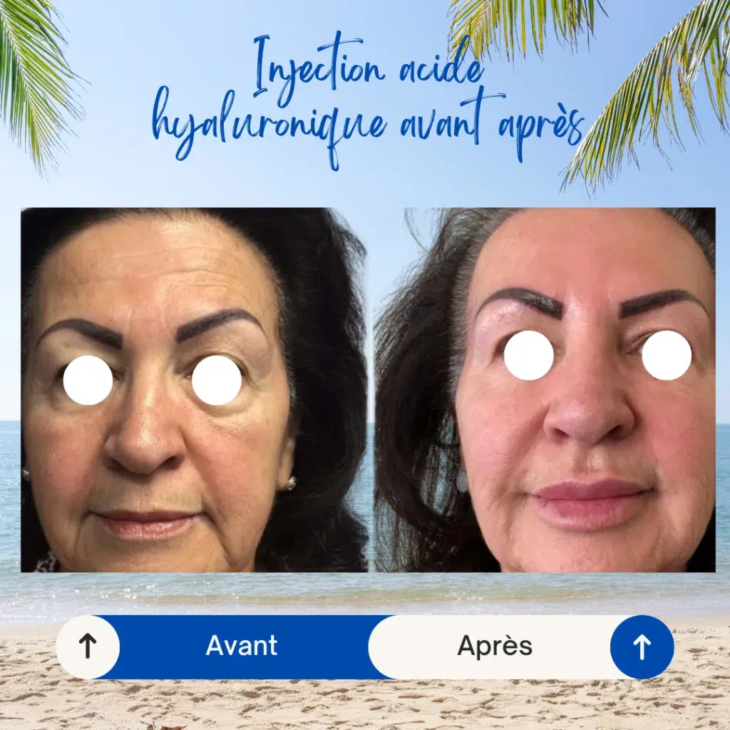 injection acide hyaluronique avant après tunisie visage estetika, Comblement des rides tunisie