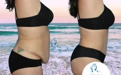 lipectomie prix Lipectomie prix