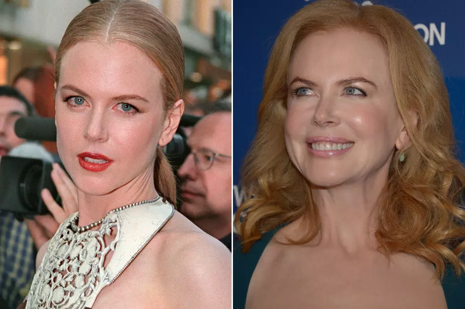 nicole kidman chirurgie esthétique