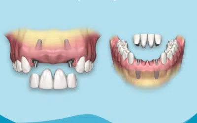 Bridge 4 dents sur 2 implants prix 1 Bridge 4 dents sur 2 implants prix