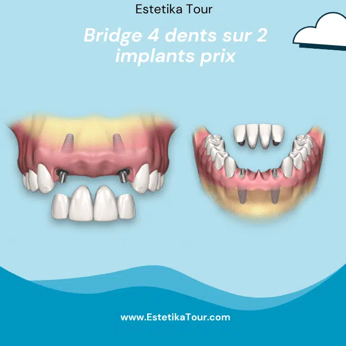 Bridge 4 dents sur 2 implants prix