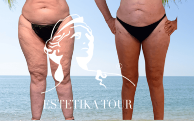 Lipoedeme operation Lipoedème operation