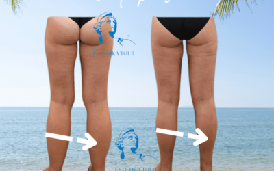 Liposuccion mollet avant apres Liposuccion mollet avant apres