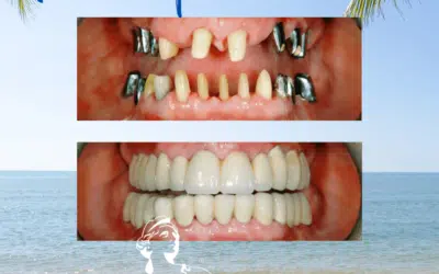 Prix implant dentaire estetika tour Prix implant dentaire