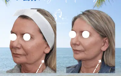 Lifting visage au Meilleur prix
