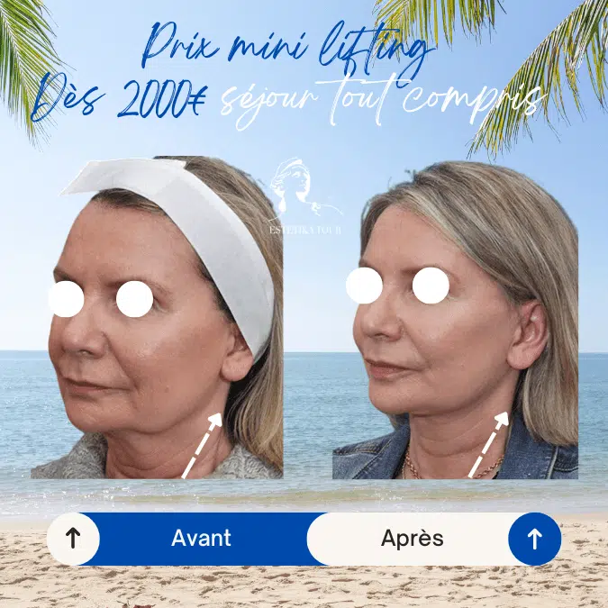 Lifting visage au Meilleur prix