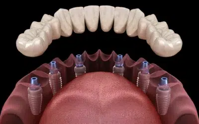 Prothese dentaire sur implant prix Prothèse dentaire sur implant prix