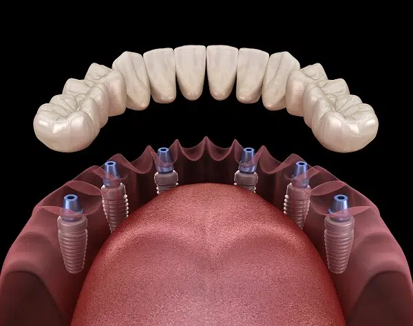 Prothèse dentaire sur implant prix
