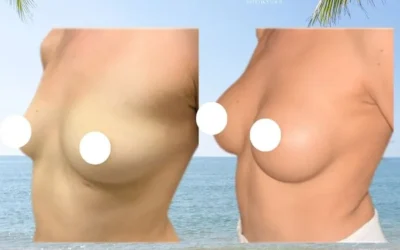 Chirurgie mammaire Nantes Augmentation mammaire prix nantes