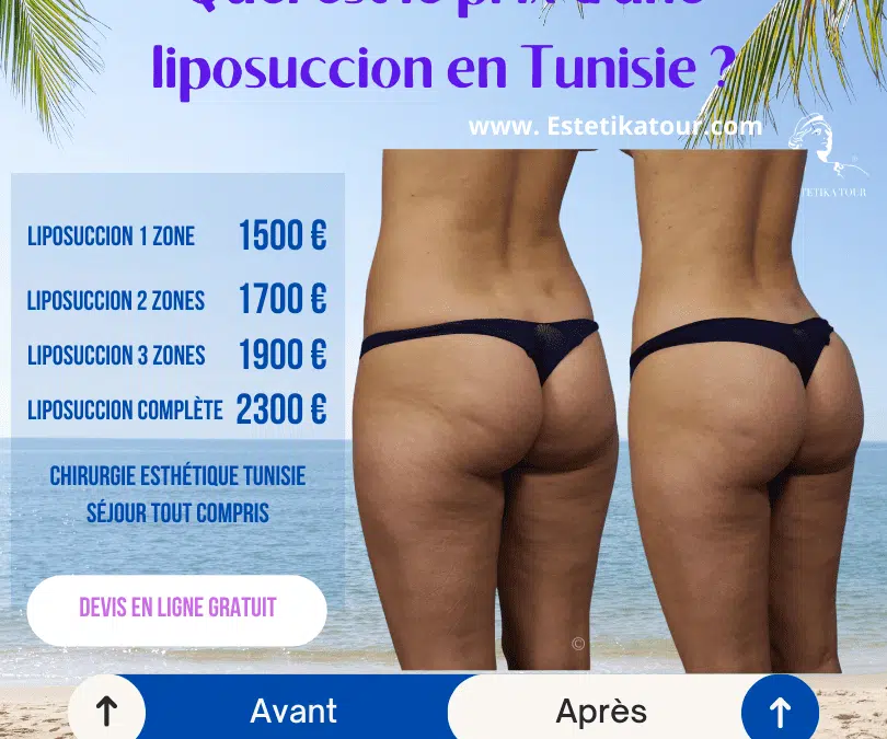 avis liposuccion