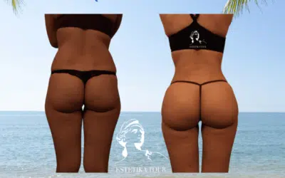 Lifting brésilien augmentation des fesses