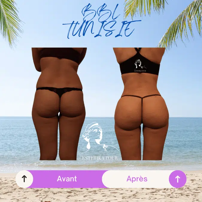 Brazilian butt lift tunisie Devis gratuit