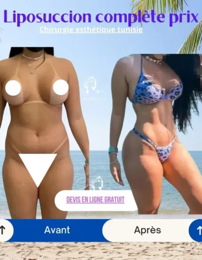 Liposuccion complète prix, apres liposuccion, Lipossucion hanche tunisie