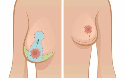 liposuccion seins 1 Liposuccion seins