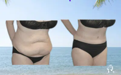 Abdominoplastie Bienfaits médicaux de l’abdominoplastie