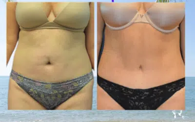 Abdominoplastie douleur témoignage