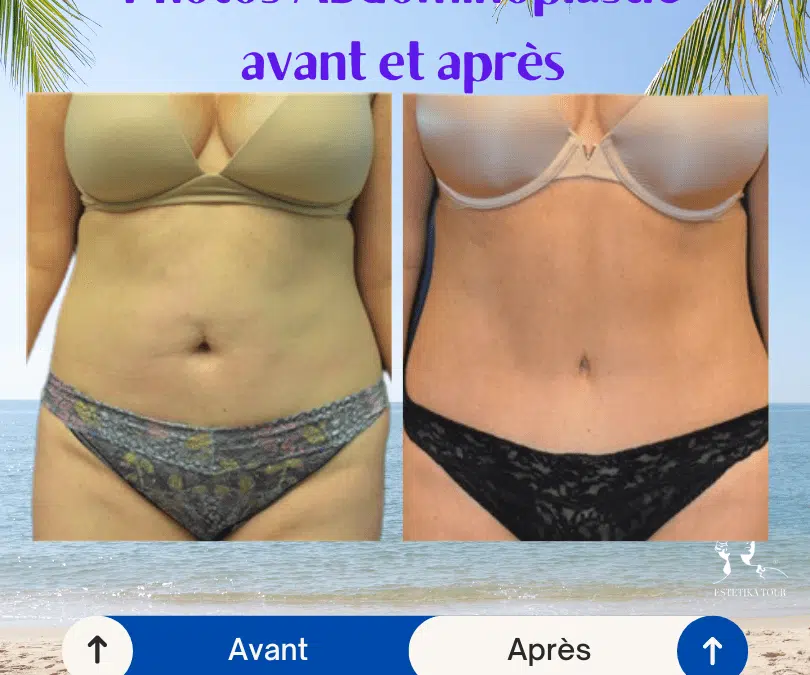 Abdominoplastie apres cesarienne prise en charge