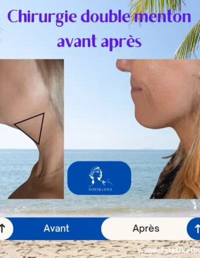 Chirurgie double menton