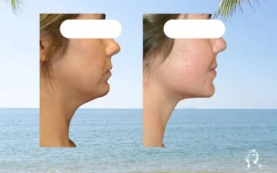 Chirurgie double menton estetika Liposuccion du visage prix devis gratuit
