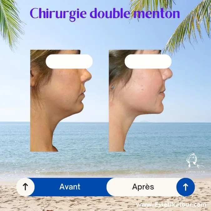 Liposuccion du visage prix devis gratuit