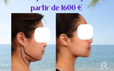 Chirurgie double menton prix tunisie Chirurgie double menton