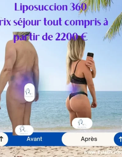 Liposuccion 360 prix, liposculpture tarif, Liposuccion complète, Aesthetic body tunisie