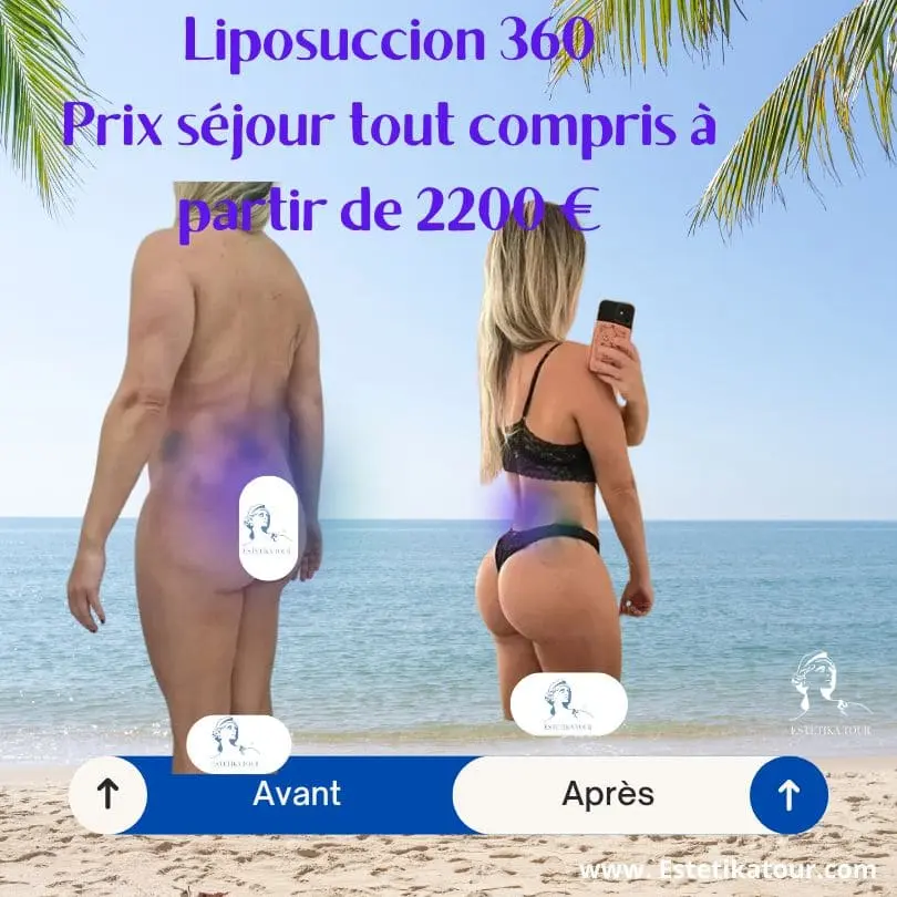 Liposuccion 360 prix, liposculpture tarif, Liposuccion complète, Aesthetic body tunisie