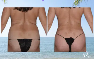 Liposuccion dos avant apres Bourrelet dans le dos