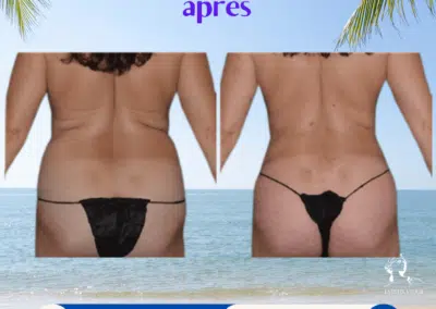 Liposuccion dos avant après, bourrelet dans le dos