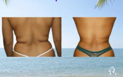 Liposuccion dos avant apres tunisie Liposuccion dos avant après