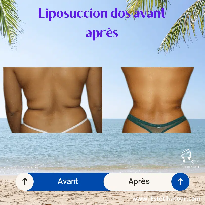 Liposuccion dos avant après