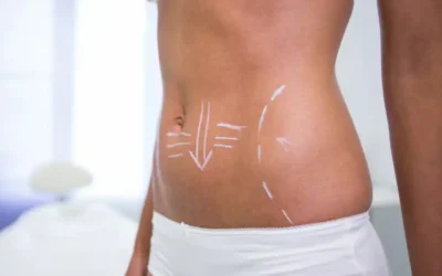 Liposuccion laser ventre prix Comment perdre du ventre rapidemment