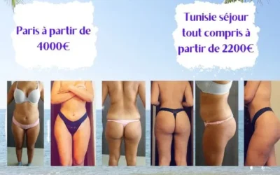 Avant et apres la chirurgie esthetique